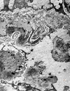 jejunum … lipid malabsorption jejunum … lipid malabsorption